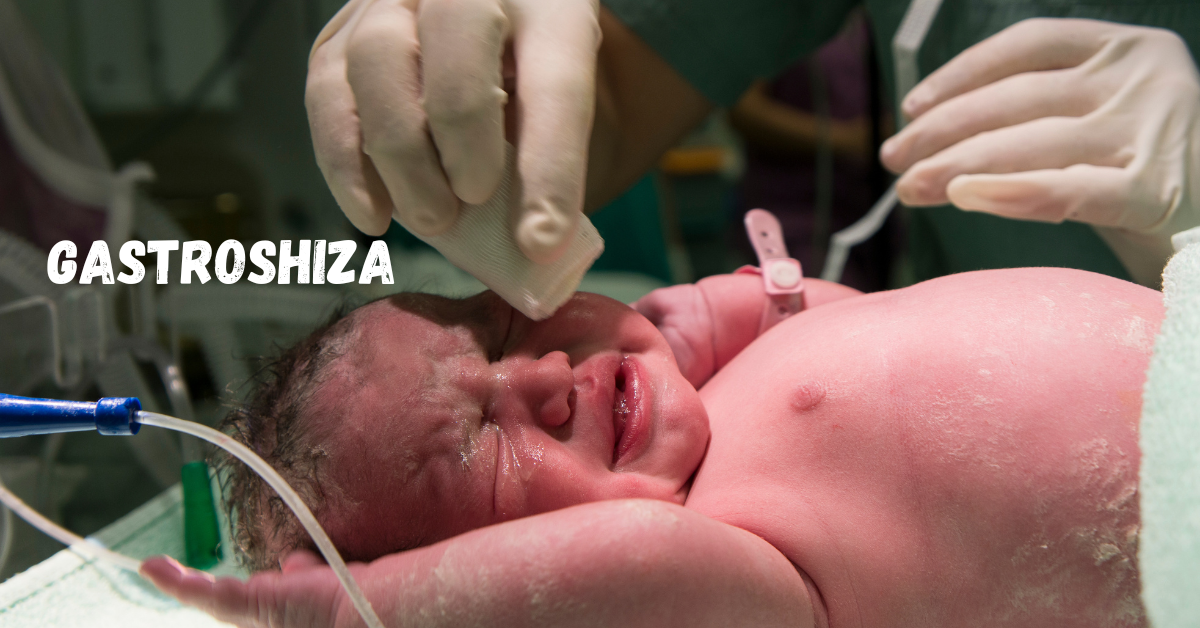 Gastroshiza
